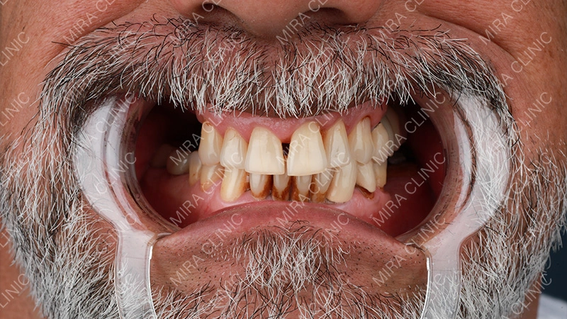 dental implants patient reviews